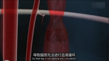 医学解读：男子腿绑香肠冒充阳物为何丧命