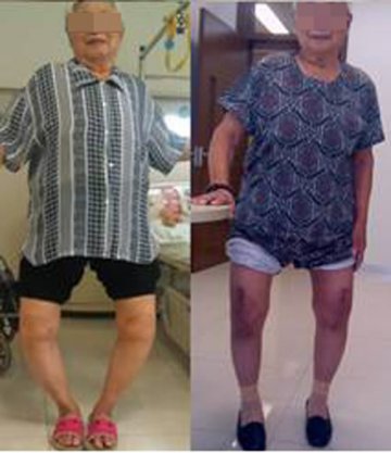 202医院完成东北首例3D人工膝关节置换术