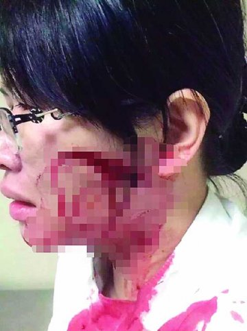 澳汉失常斩伤护士