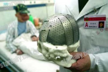 狮面人患骨换头盖骨手术备有两方案
