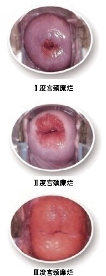 宫颈糜烂，治疗不能“过”
