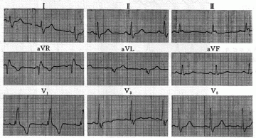 右束支传导阻滞Right Bundle Branch Block