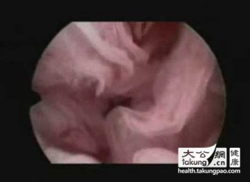 神奇的生命：实拍女性排卵真实过程