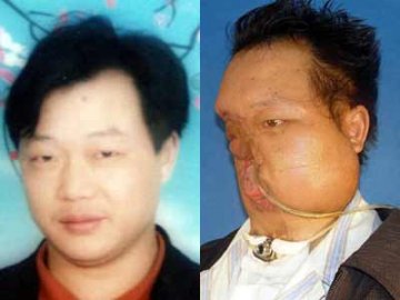 西安医院今天为缺面男进行造脸手术