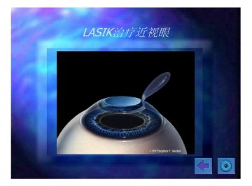 lasik16