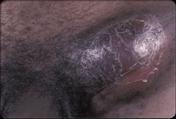 性病淋巴肉芽肿