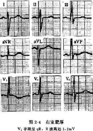 右心室肥厚 Right Ventricular Hypertrophy