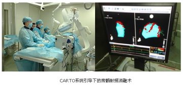 大坪医院成功开展心房颤动射频消融术