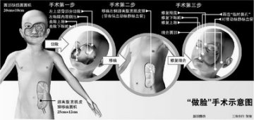 贵州怪脸女孩做脸后仍受遗传病影响