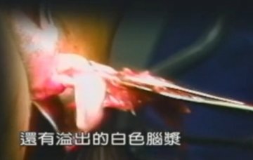 实拍：美国堕胎手术全过程
