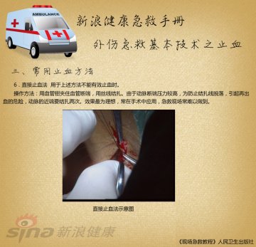 常用止血方法：直接止血法