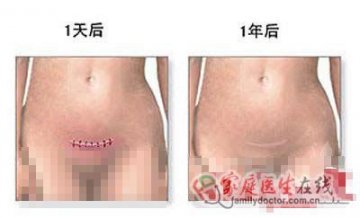 医学图解：剖腹产手术全过程