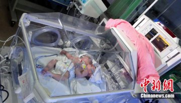 罕见“双头单体女婴”存活15天 多地专家会诊