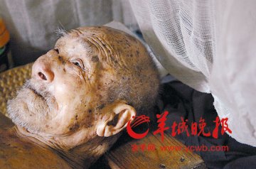 苦命漏斗胸女孩不幸夭折 爱心延续至其爷爷