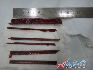 7岁男孩从树上摔下 致体内暗藏6根竹片