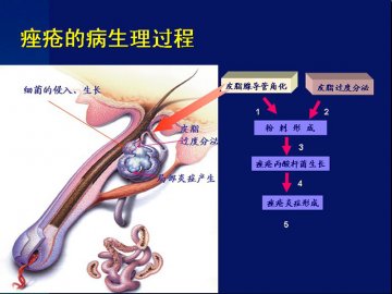 军医支招阻止痤疮毁面 向顽固“青春痘”说再见