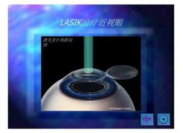 lasik12