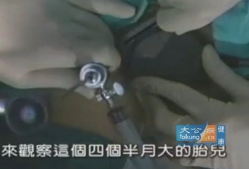 实拍堕胎手术全过程 呼吁珍惜生命
