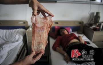湖南一女子体内取出大片纱布 疑为半年前手术所留