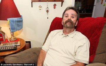 美男子脸上被挖大洞终整容成功