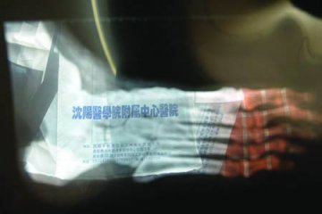 患者被医院盗取骨髓用于试验