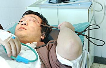 老婆恼怒老公搓麻将火钳深深插入其脑中