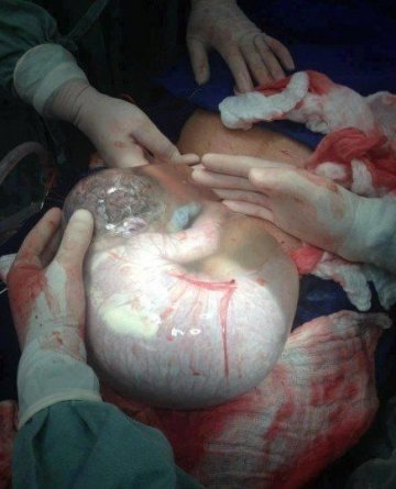 实拍剖腹产宝宝出生瞬间