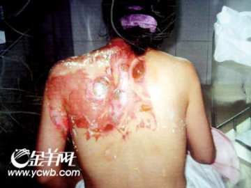 女宾拔火罐被烧成重伤