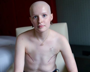 高清：解禁！国外乳房切除手术后照片
