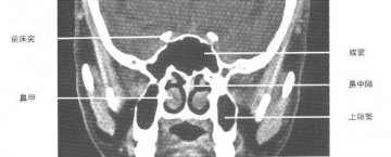 正常鼻咽鼻窦CT（4）