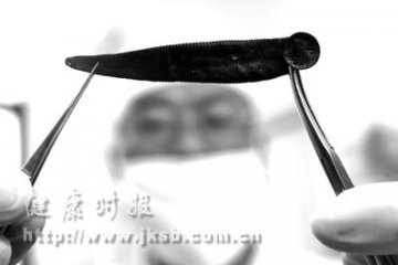7.5厘米长的蚂蝗导致的“喉癌”