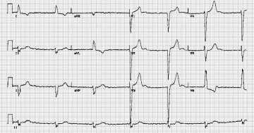 完全性房室传导阻滞伴心房纤颤Atrial fibrillation and complete heart block