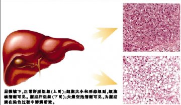 肝病第二大杀手：脂肪肝