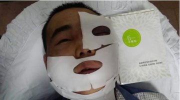 被蚊子叮脸肿成球男子 现已神奇消肿