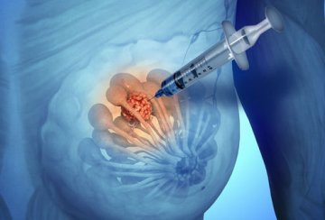 乳腺活组织检查