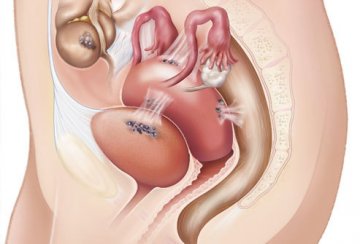 子宫内膜异位的症状