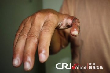 移植手术致医疗事故 院方置之不理