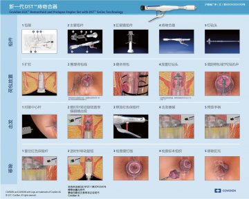 痔吻合器及附件-官方高清创意广告(沪医械广审(文)第2013010060号)