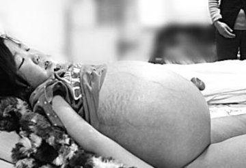 7龄女童生怪病饭量猛增腹胀如鼓