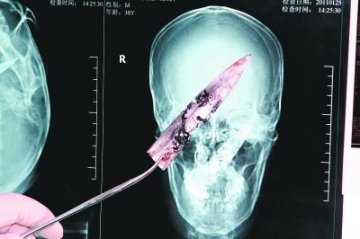男子治疗口腔疾病发现脑中残留断刀