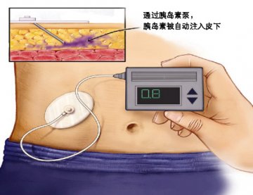遇上“带泵”患者