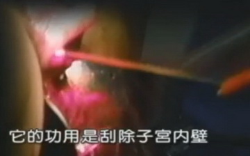 实拍少女人流全过程