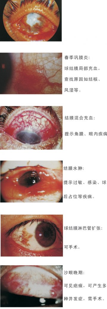 春季巩膜炎、结膜混合充血、结膜水肿、球结膜淋巴管扩张、沙眼晚期