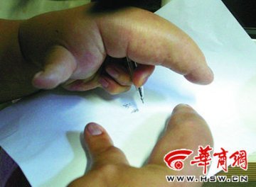女子双手巨指畸形中指长近乎正常手指两倍