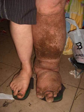 全球最恐怖的67种怪病