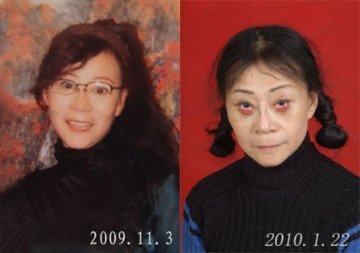 女子花万元除皱整容 术后眼睑外翻吓人