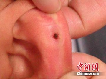唐山首位蜱虫叮咬者渡过观察期 专家提醒勿恐慌