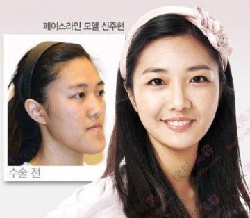 31个惊人韩国整容案例