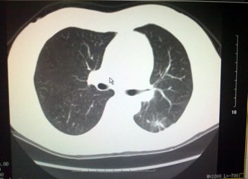 大坪医院肺外科成功开展世界首例3D CT引导电视胸腔镜下肺毛玻璃样变（GGO）切除术