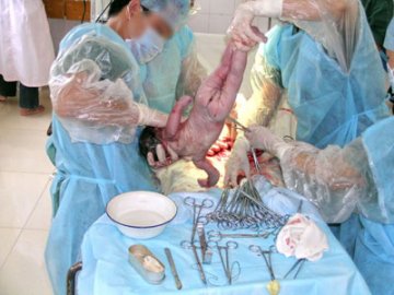 实拍剖腹产全过程